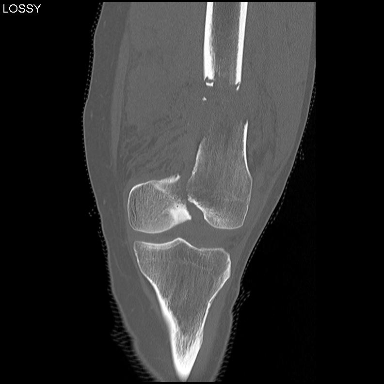 Distal Femur Fracture Intercondylar CT